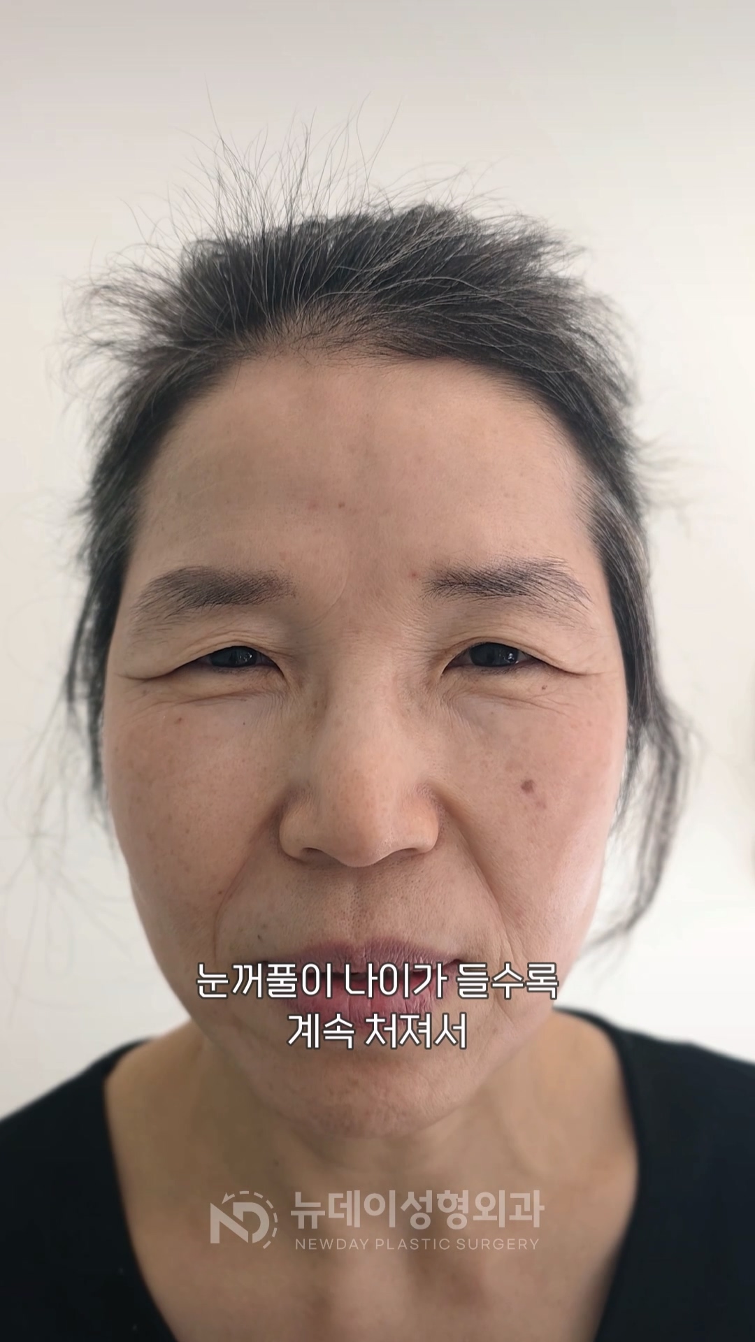 짓눌린 눈꼬리와 겹주름의 60대 여성, 상안검 후 달라진 눈매