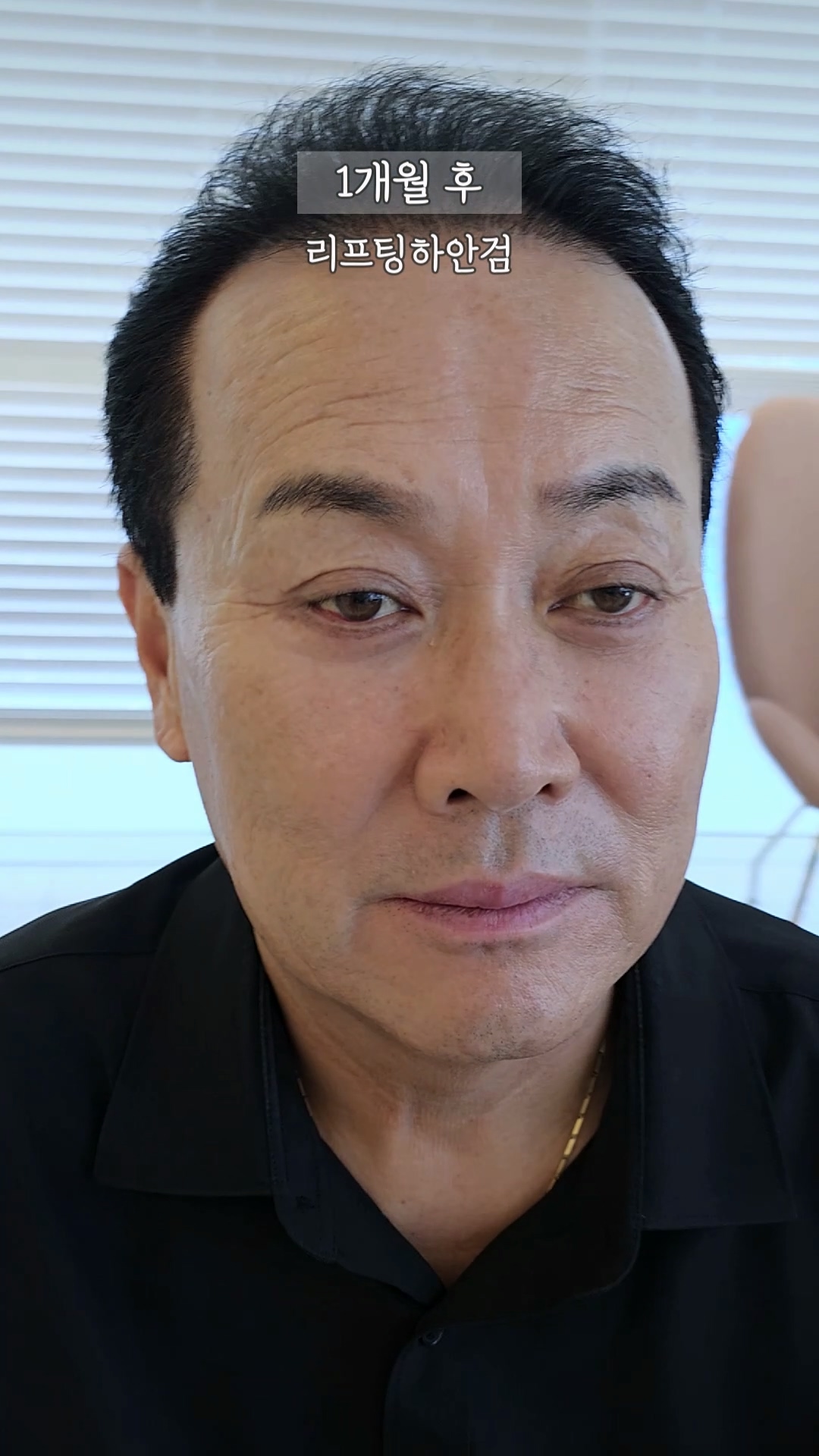 하안검 1개월 후, 자신감을 되찾은 60대 중반 남성