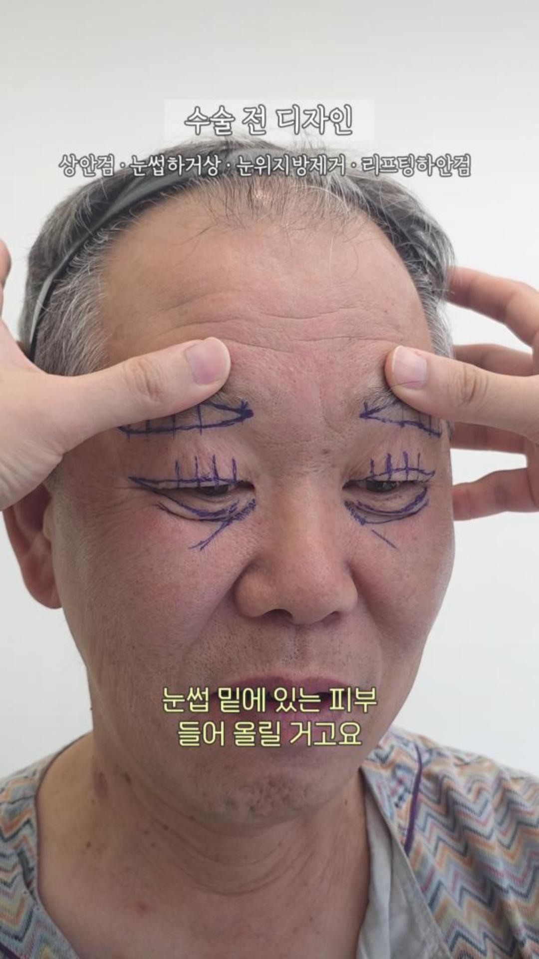 2주 후 달라진 60대 중반 남성의 눈매 #상안검 #눈썹하거상 #하안검
