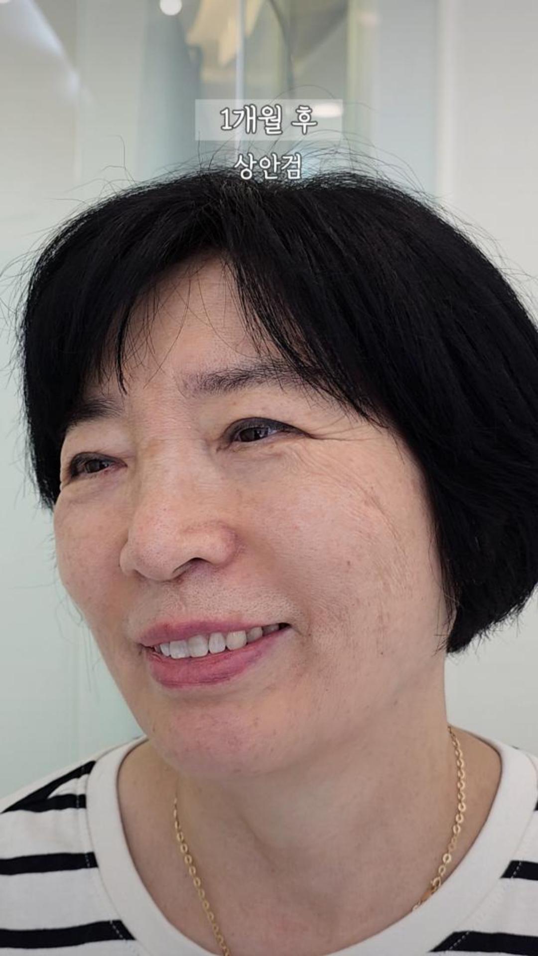 상안검 1개월 후, 탄력 있고 또렷해진 눈매의 60대 여성