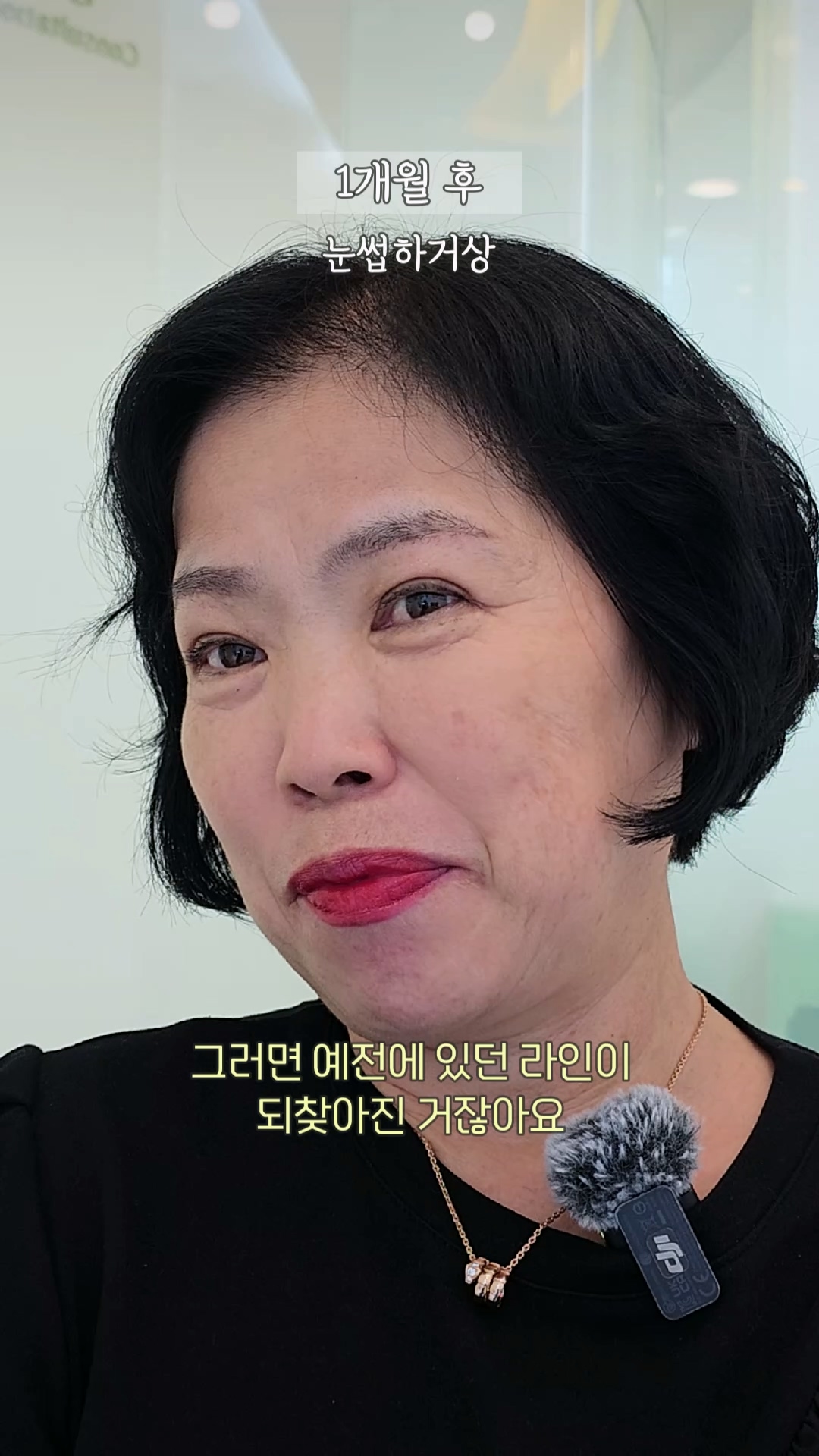 눈썹하거상 1개월 후, 60대 여성의 또렷해진 눈매