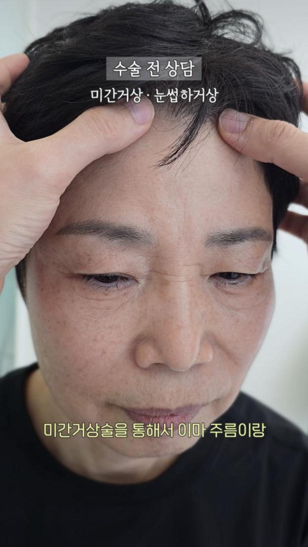 미간거상·눈썹하거상 1개월 후, 달라진 60대 여성의 인상