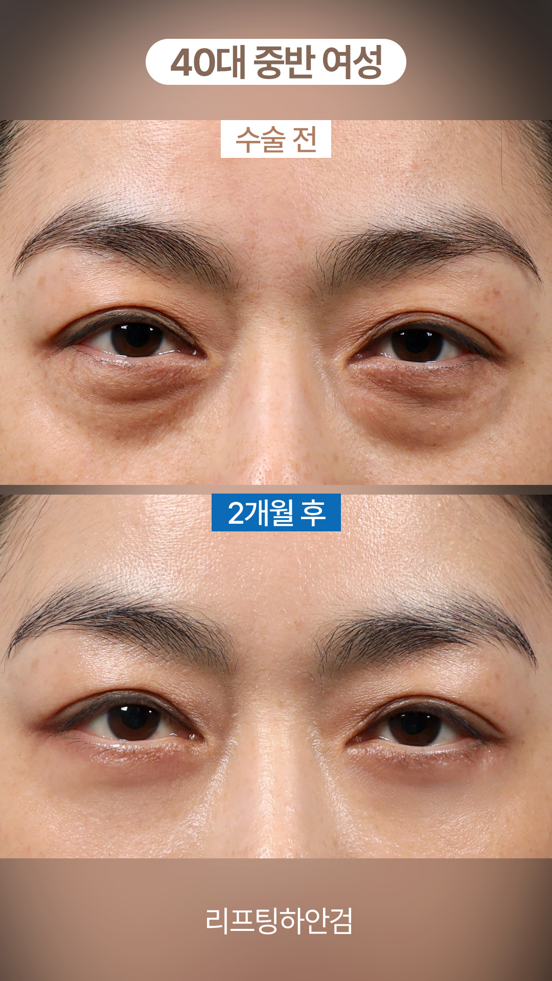 불룩하고 어두워 보이는 눈밑, 40대 중반 여성의 변화 #하안검