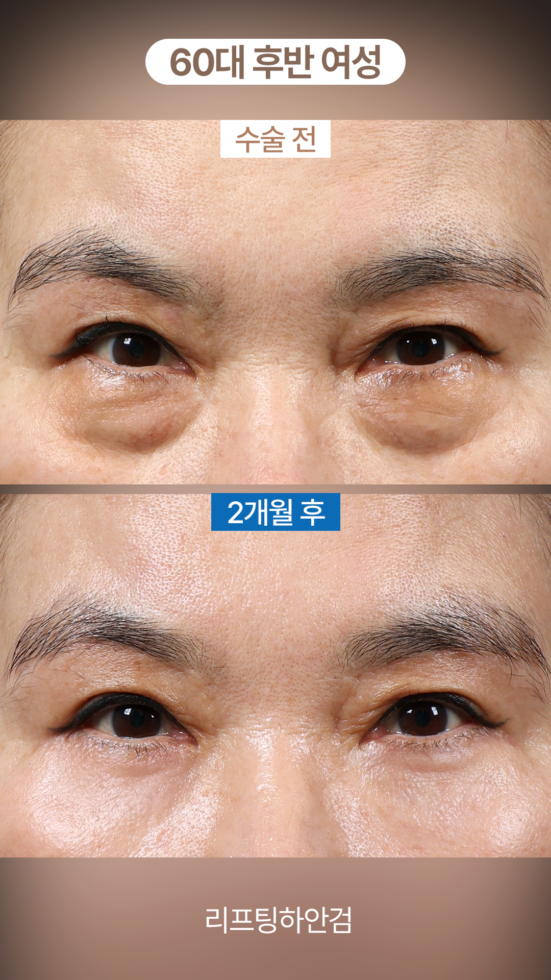 60대 후반, 눈물고랑과 불룩한 눈밑의 변화 #하안검