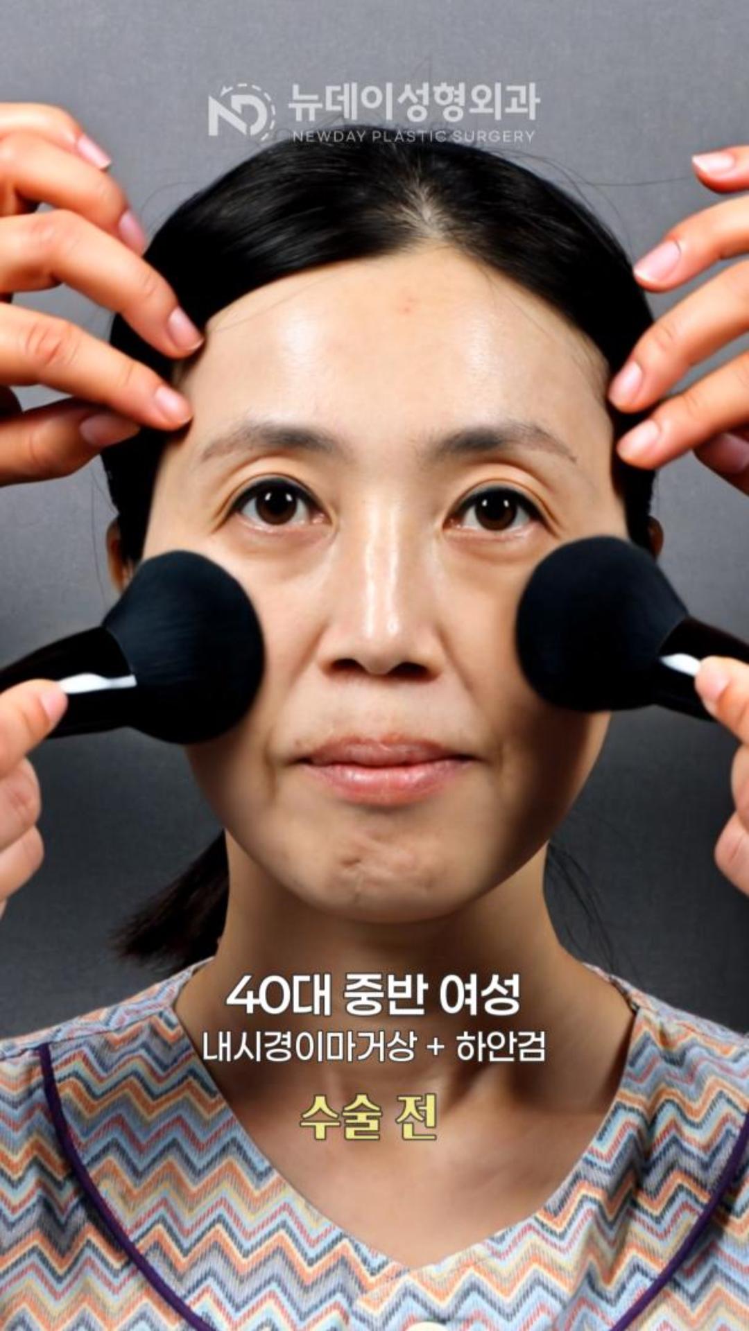 40,50대 중년성형, 전후 차이는 얼마나 달라졌을까요?