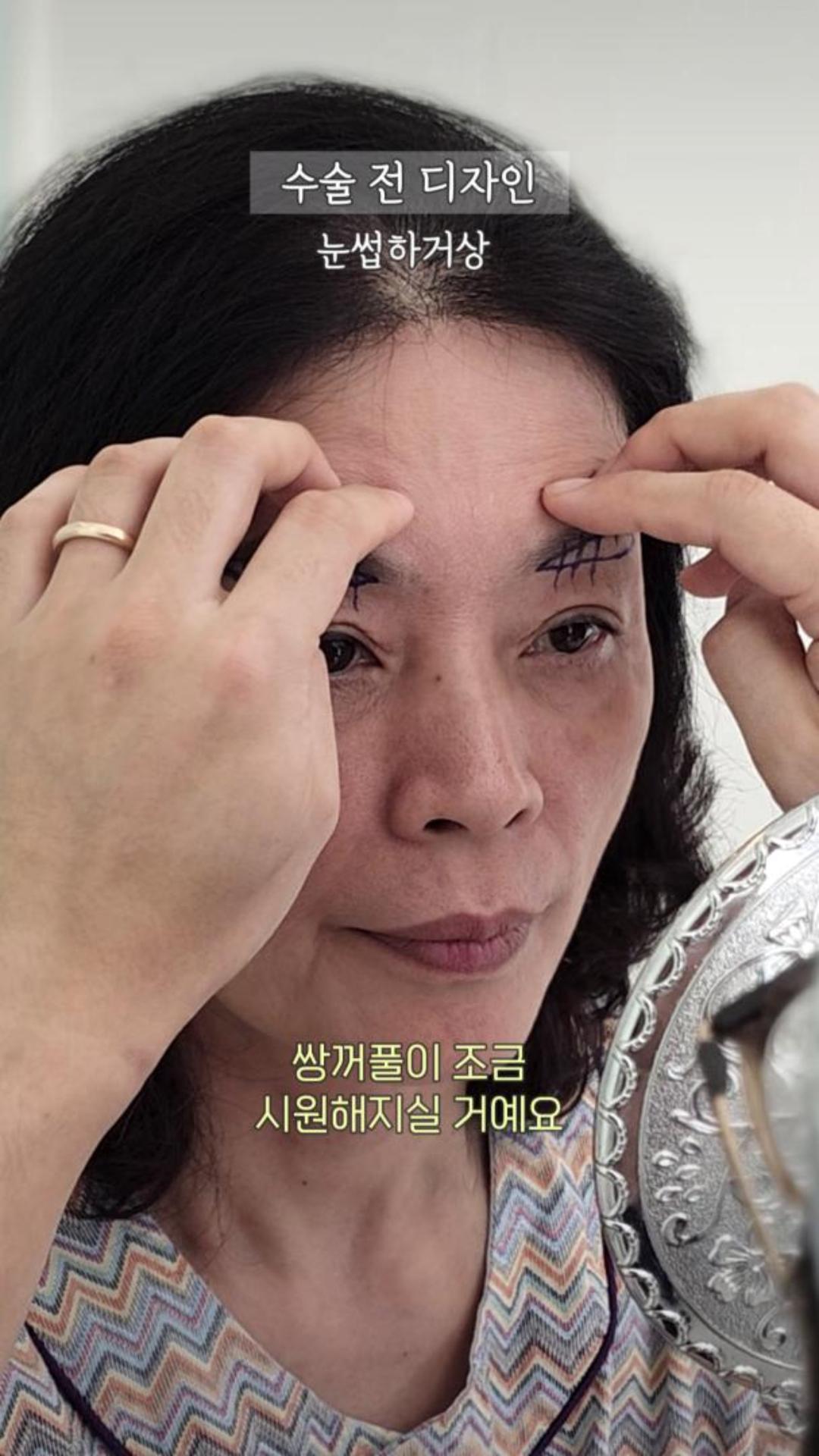 눈썹하거상 1주 후, 한결 또렷해진 60대 여성의 눈매