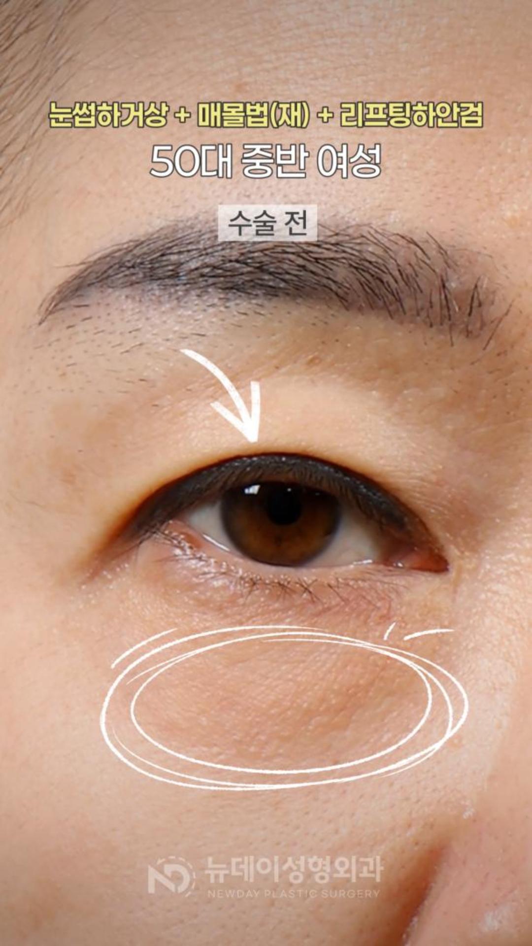 쌍꺼풀 라인을 덮는 눈위 처짐과 불룩한 눈밑이 고민인 50대 중반 여성