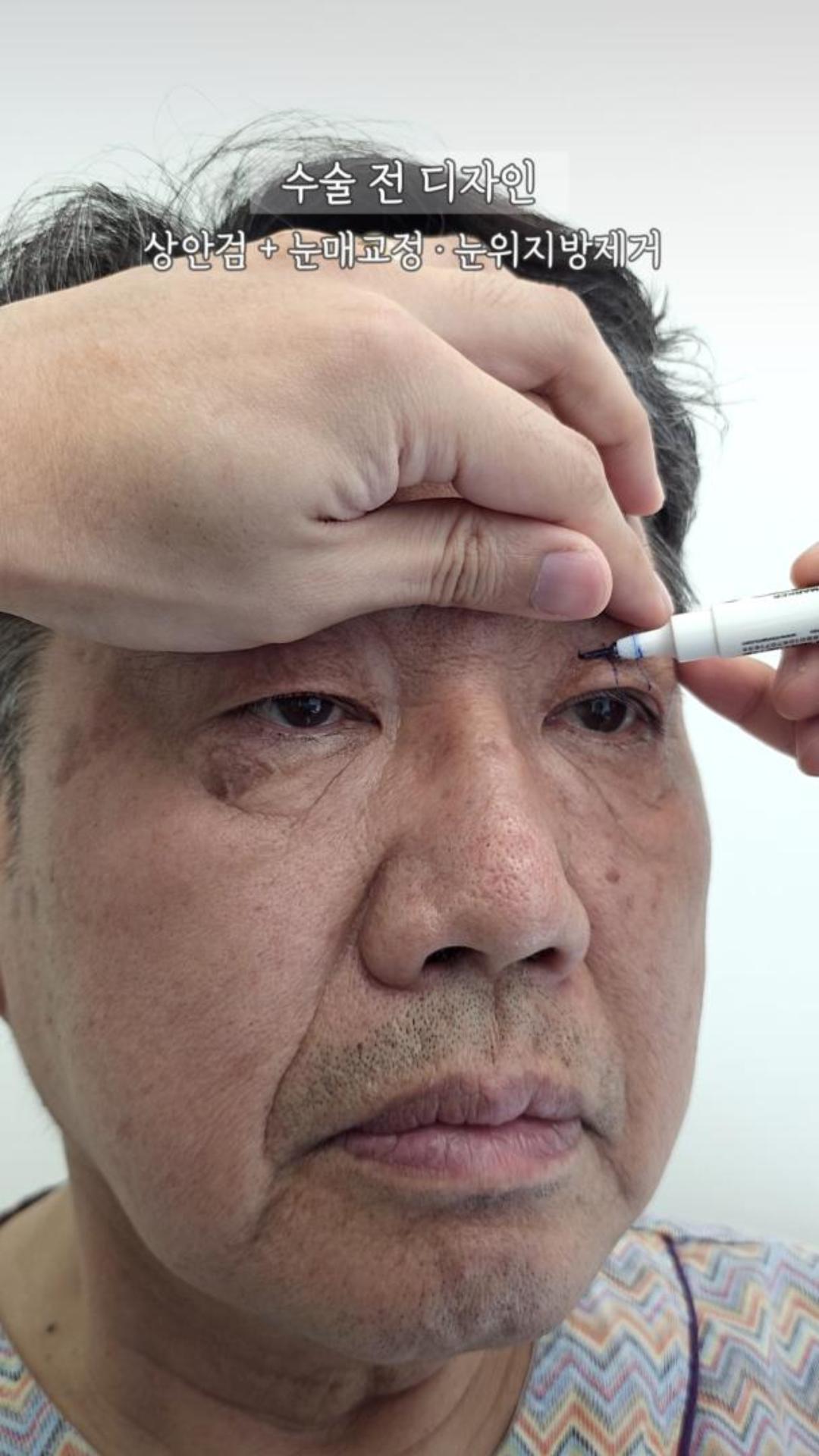 처지고 답답했던 눈매, 60대 남성의 상안검 1주 후 변화