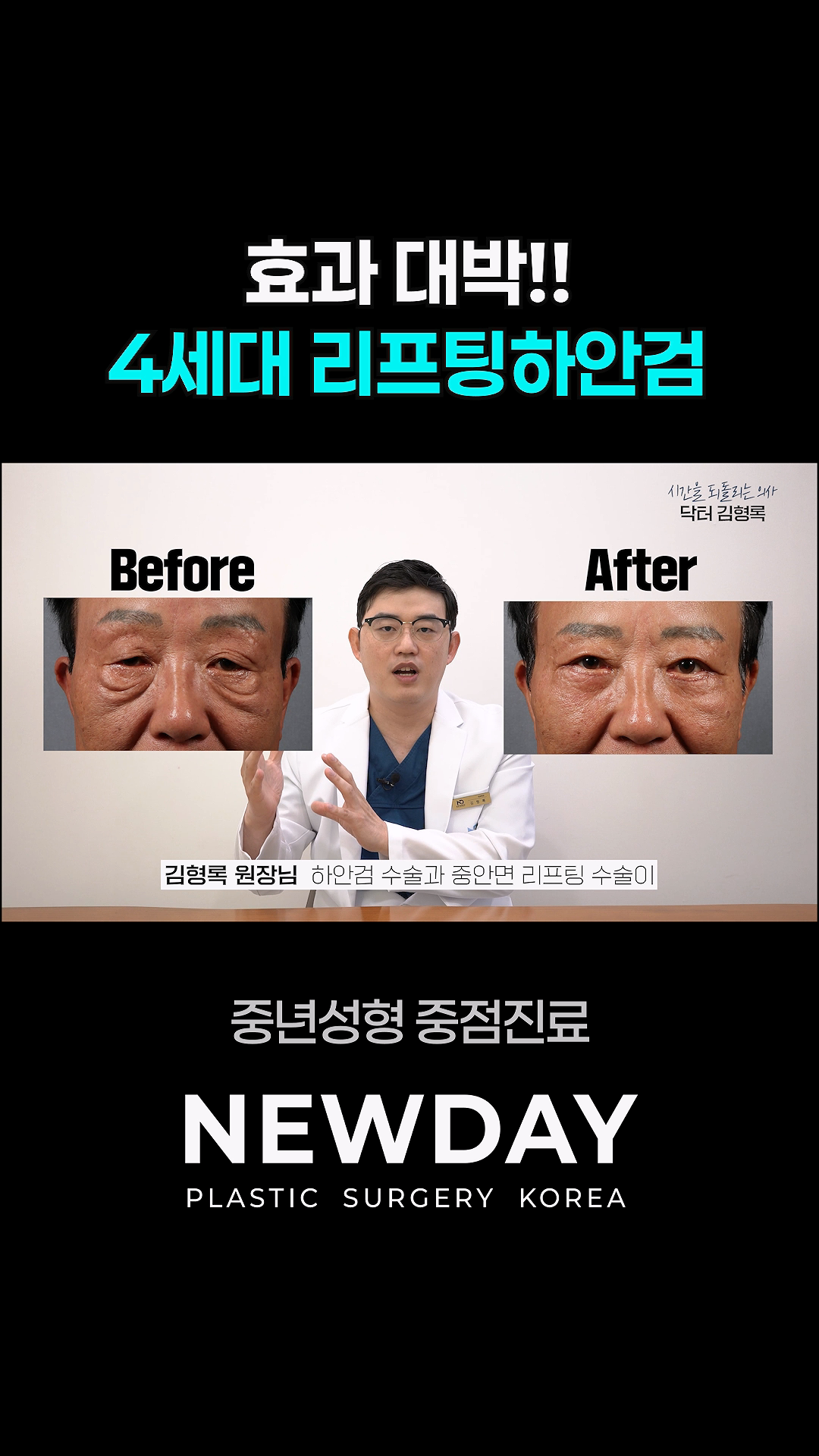 4세대 리프팅하안검, 무엇이 다를까요?