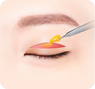 절개창을 통해 과도한 피부·근육·지방을 제거하는 단계