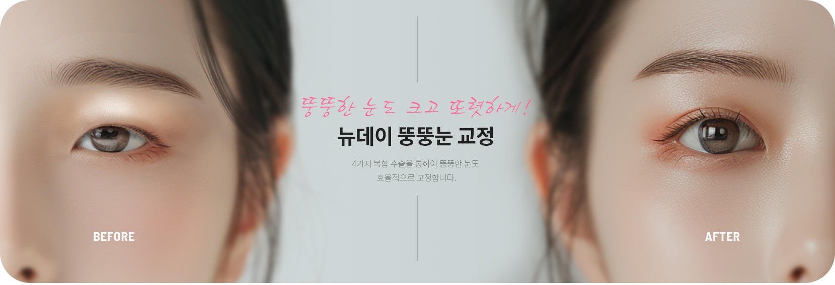 뚱뚱눈 교정 전후 비교