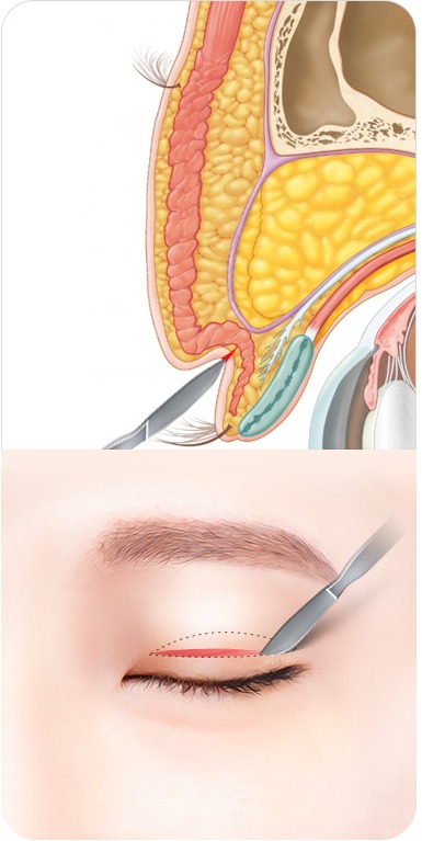 디자인에 따라 눈꺼풀을 절개하는 단계