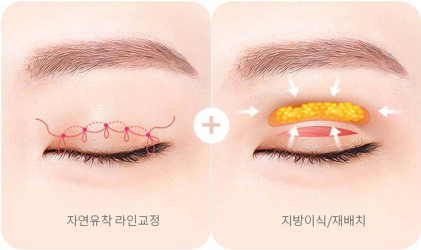 피부가 얇고 함몰된 겹주름 - 자연유착 라인교정과 지방이식