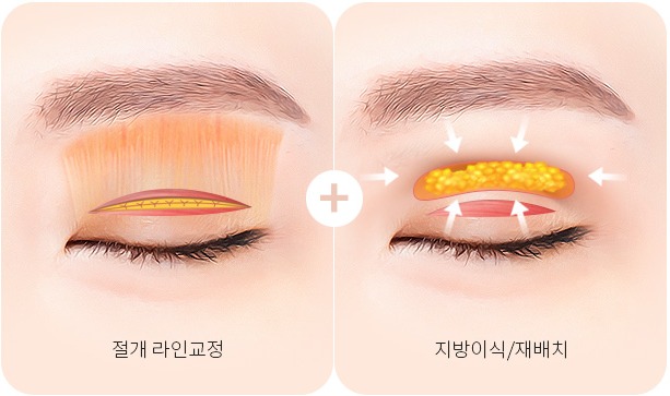 피부가 두껍고 함몰된 겹주름 - 절개 라인교정과 지방이식