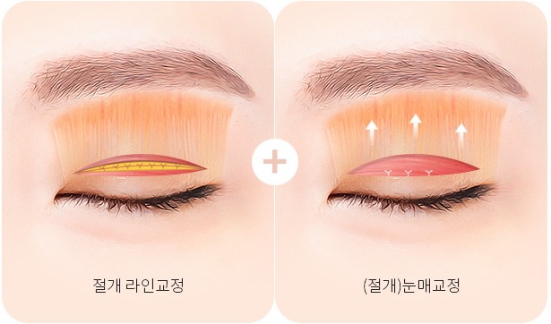 피부 두껍고 풀린 겹쌍꺼풀 - 절개 라인교정과 눈매교정