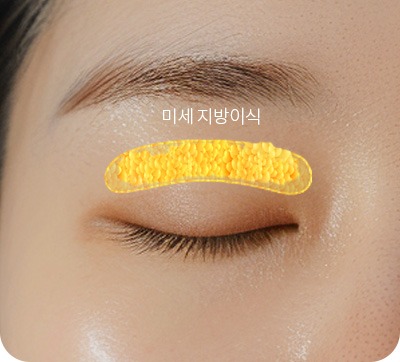 눈두덩 지방이식 시술 부위