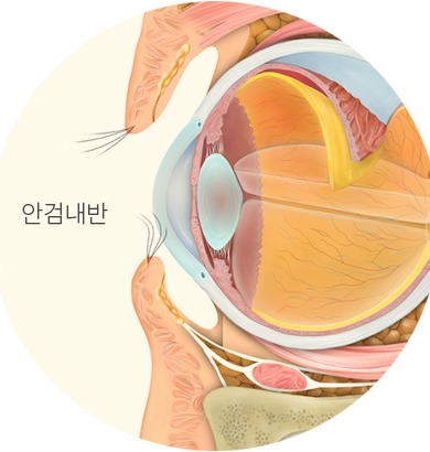 안검내반 단면 비교
