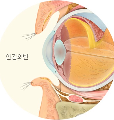 안검외반 단면 비교