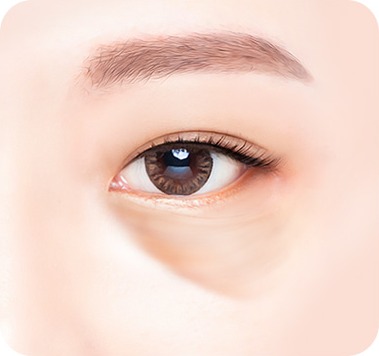 수술 전 - 불룩한 눈밑과 푹 패인 눈물고랑