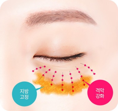 격막 강화와 지방 고정