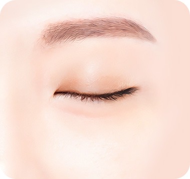 수술 후 - 깔끔하게 교정된 눈밑