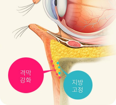 지방 고정과 격막 강화 구조