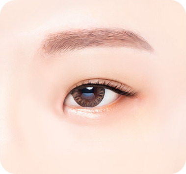 수술 전 - 앞트임