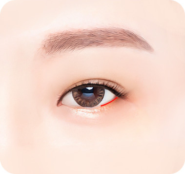 미세 절개 - 밑트임