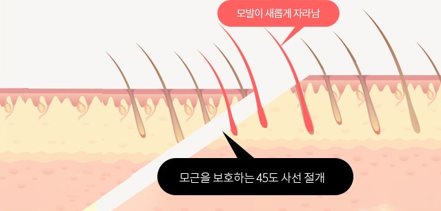 사선절개로 모근을 보호하는 반흔성 탈모 부담 감소 도해