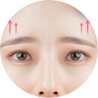 처지고 답답한 눈매를 교정한 모습