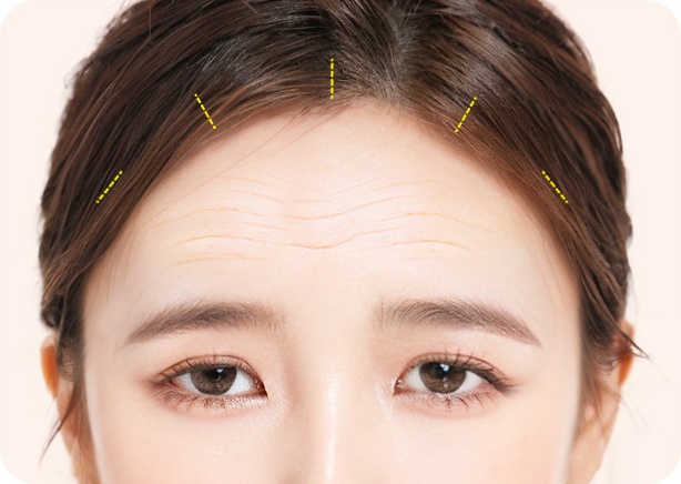헤어라인 안쪽으로 3~5군데 절개
