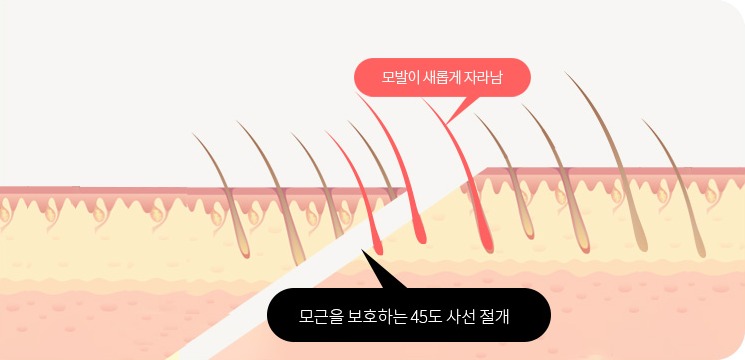 헤어라인 절개 부위의 모근을 보존하는 이마축소술