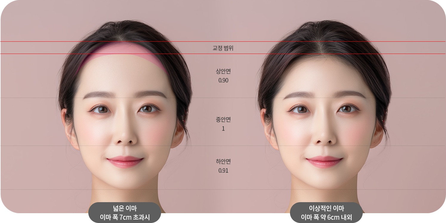 얼굴 황금비율에 따른 넓은 이마와 이상적인 이마 비교