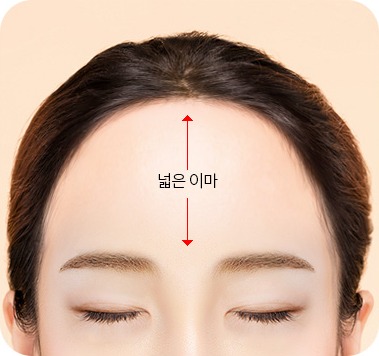 얼굴 비율에 맞지 않게 이마가 넓은 수술 전 상태