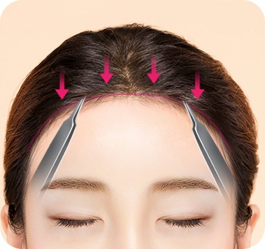 두피를 앞으로 당겨 내리고 겹치는 피부를 절제하는 모습