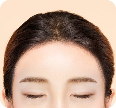 넓은 이마가 좁아진 수술 후 모습