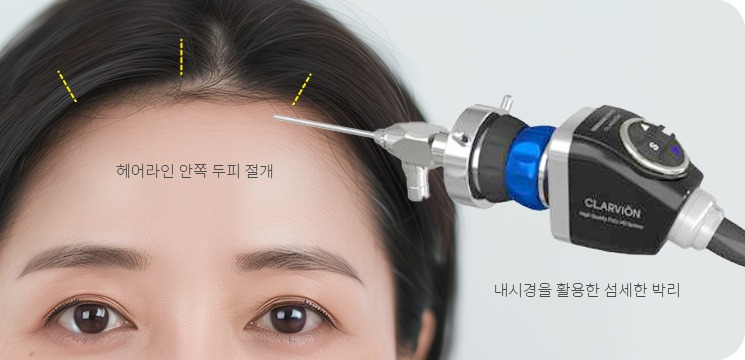 헤어라인 작은 절개와 내시경을 이용한 섬세한 미간거상술