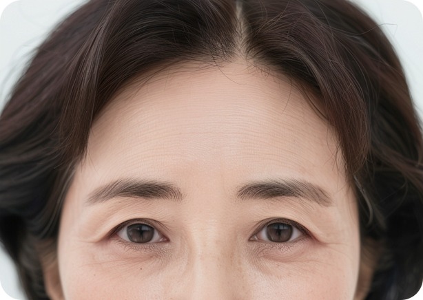 사나운 눈썹 모양과 미간주름이 개선된 모습