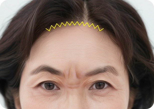 헤어라인을 따라 지그재그로 모낭보존 절개하는 모습