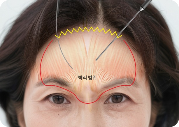 내시경으로 이마와 미간 부위를 섬세하게 박리하는 모습