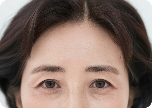 사나운 눈썹 모양과 미간·콧등 주름이 개선된 모습