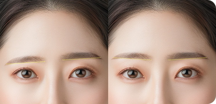 반썹거상술로 비대칭 눈썹을 교정한 모습