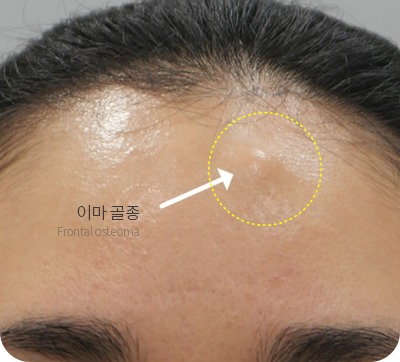 이마의 혹인 골종을 말끔하게 제거해 매끈해진 이마라인