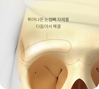 돌출된 눈썹뼈 자체를 다듬는 내시경 눈썹뼈 축소술