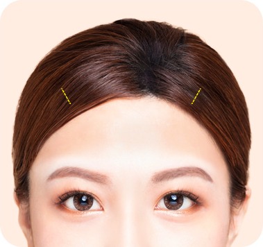 두피 안쪽을 작게 절개하는 모습