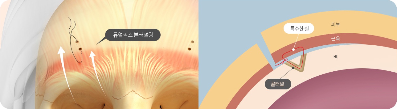듀얼픽스 본터널링 고정 — 특수한 실과 골터널로 피부·근육·뼈 층에 고정