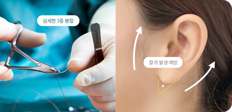 섬세한 3중 봉합술로 흉터와 칼귀 발생을 예방하는 도해