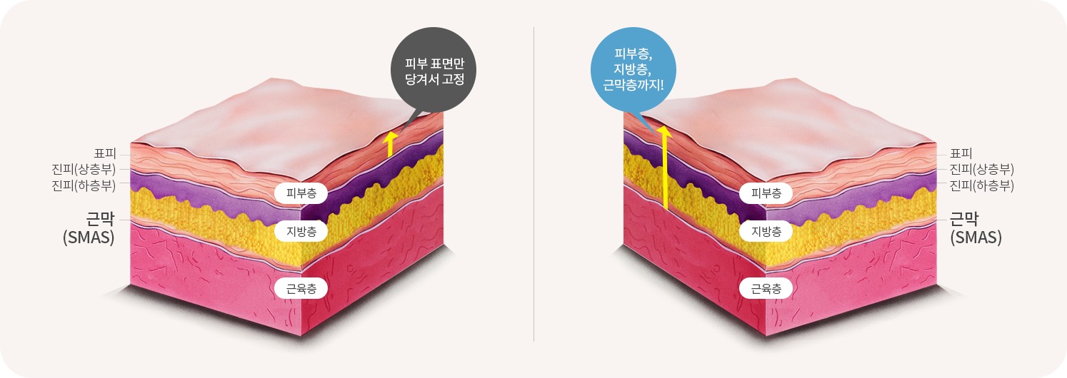 피부만 리프팅할 때와 근막층(SMAS)까지 리프팅할 때의 피부 단면 비교 도해