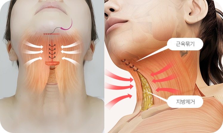 턱밑거상술로 목 정면 주름과 지방을 개선하는 도해