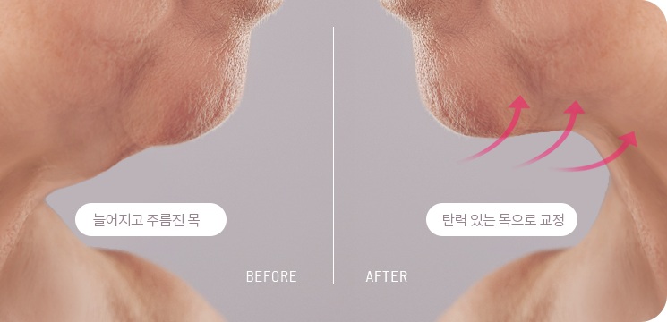 턱밑거상술 전후 목주름과 처짐이 개선된 비교 사진
